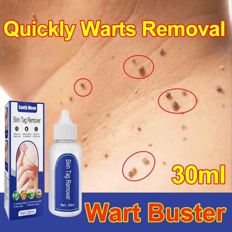 【Wart Killer】Wart Removal Origina 30ml, effectively remove and cure