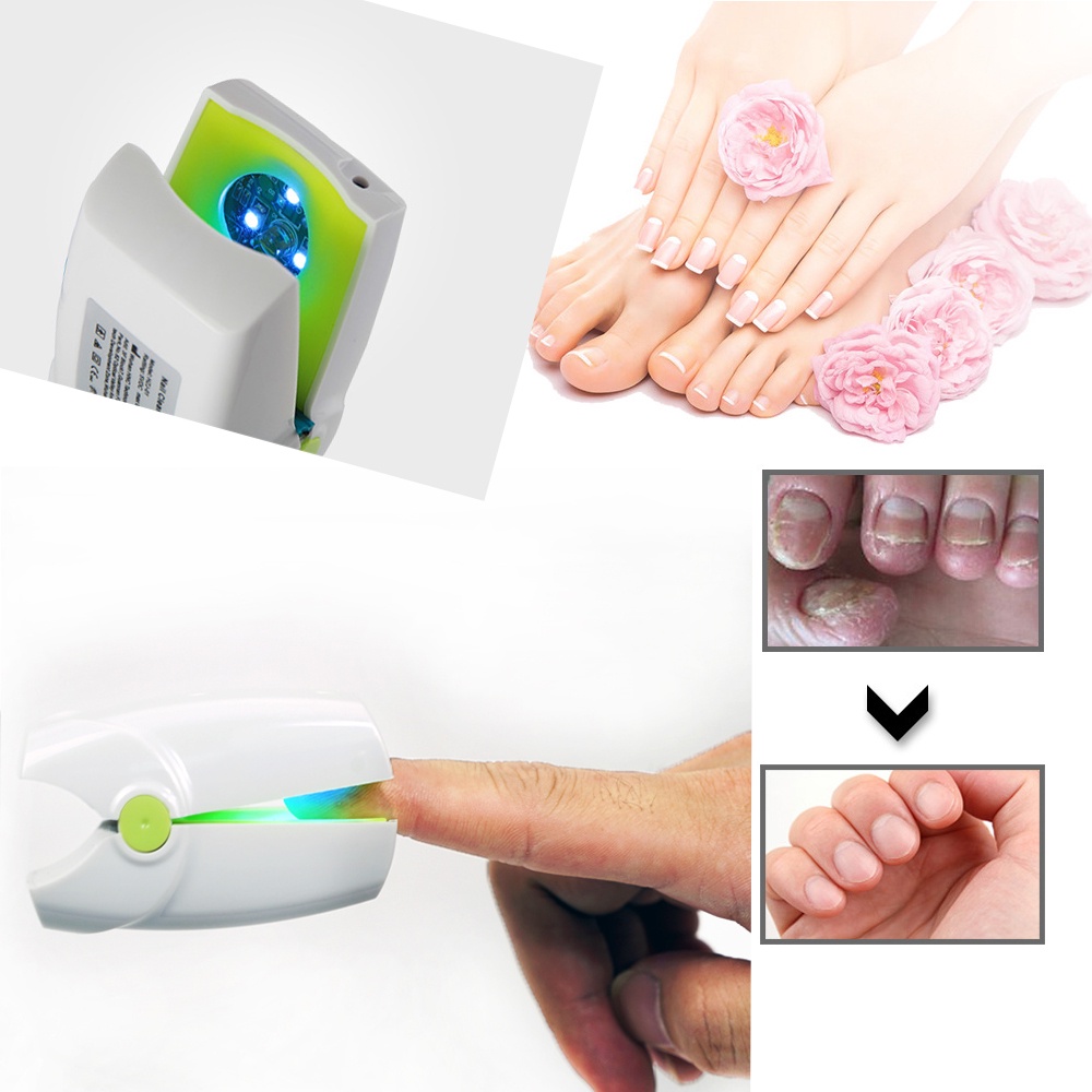 Sale CE Nail Fungus Onychomycosis Clean Laser Treatment Anti ToeNail