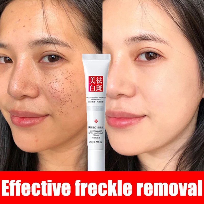 YANJIAYI Freckle Whitening Cream Dark Spot Remover 20G Shopee Philippines