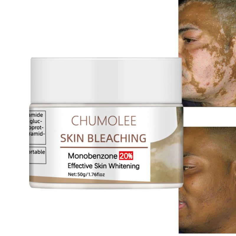 Chumolee Monobenzone Skin Bleaching Face Whitening Cream Vitiligo