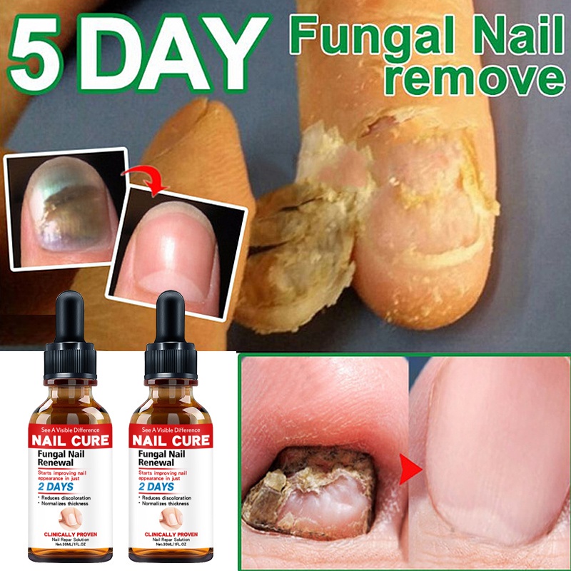 New Toenail Fungus Treatment Fungus Removal Treatment Anti Infection