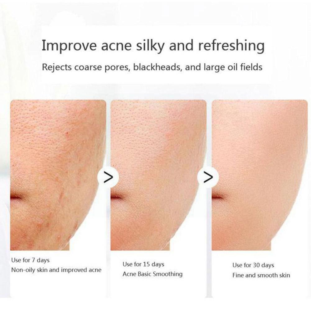 Retinol Soap Natural Soap Mites Acne Remove Pimple Pores Acne Treatment