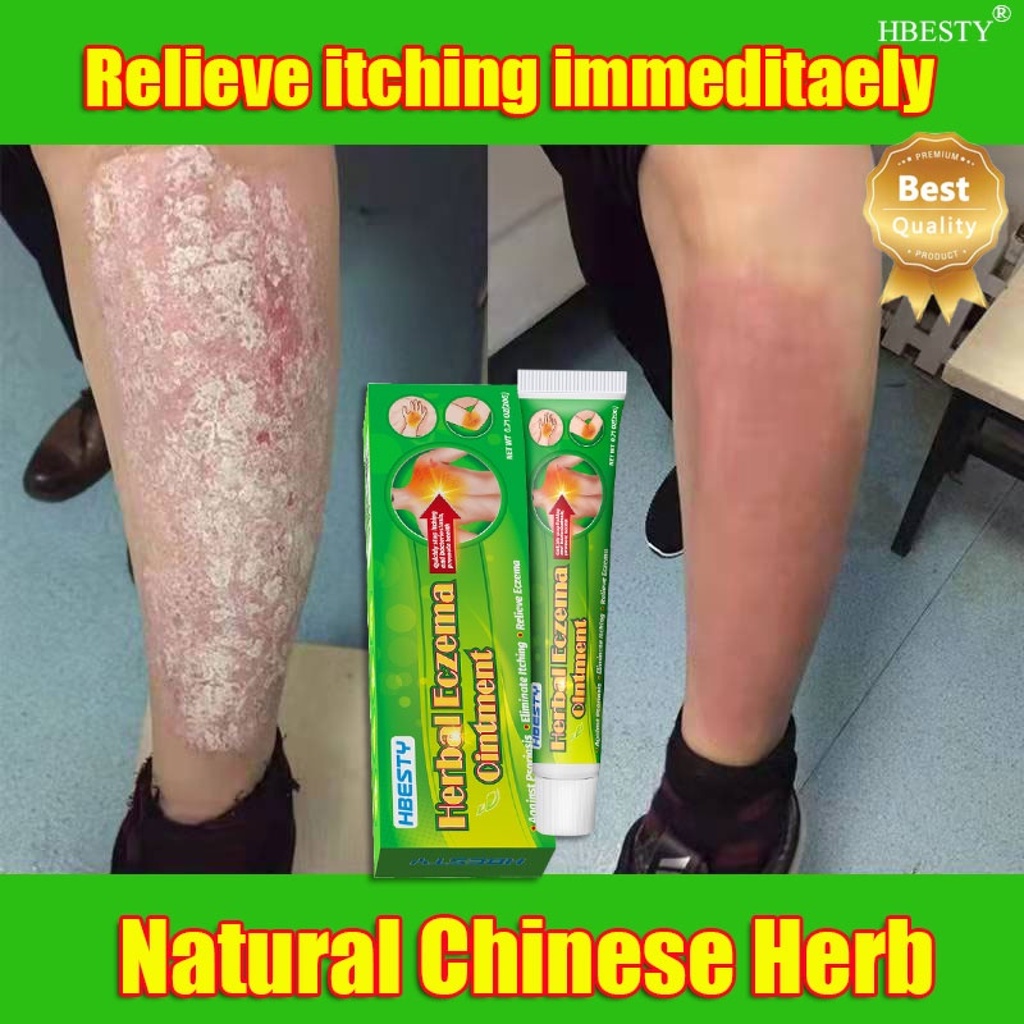 HBESTY Psoriasis Eczema Cream for Psoriasis Eczema Rosacea Acne