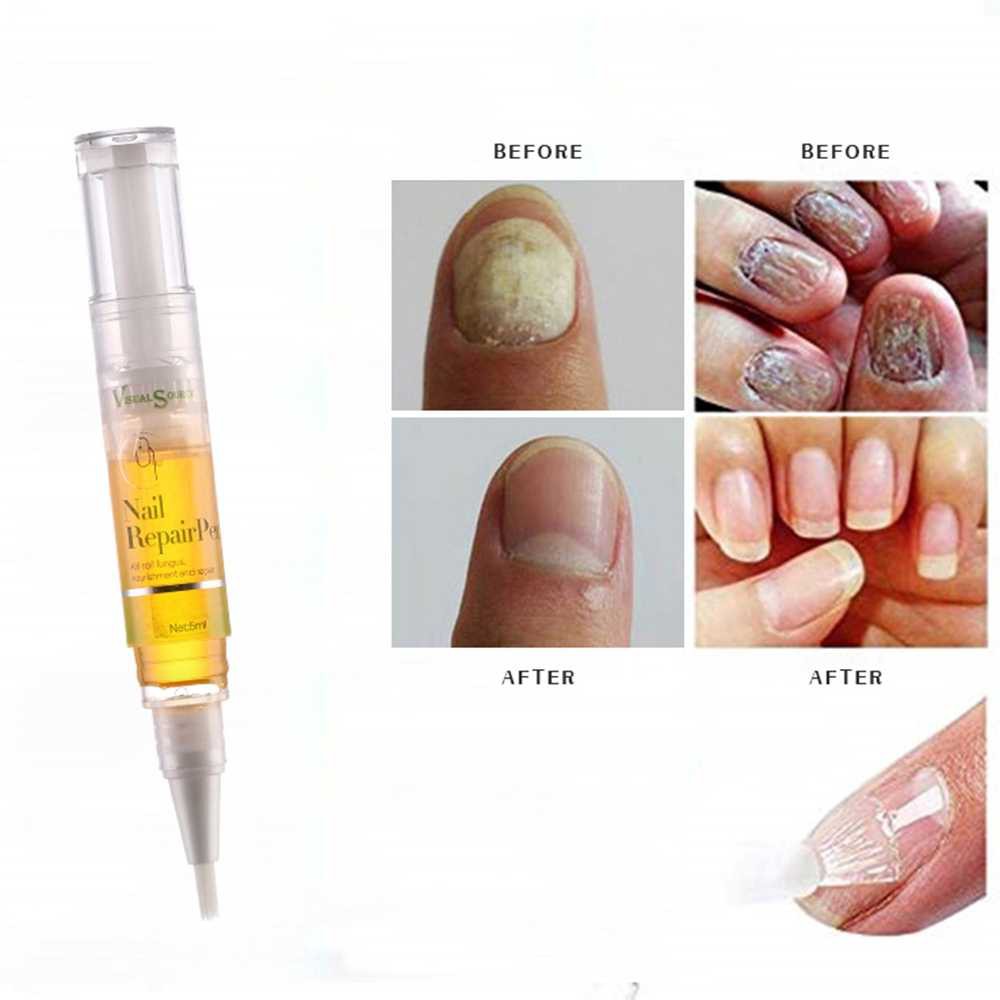Infection Liquid Nail Onychomycosis Fungal Treatment Ice Anti Pen