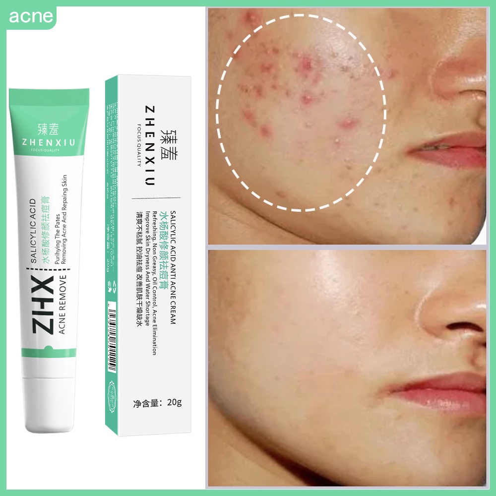 Salicylic Acid Acne Cream Remove Blackhead Oil Control AntiAcne
