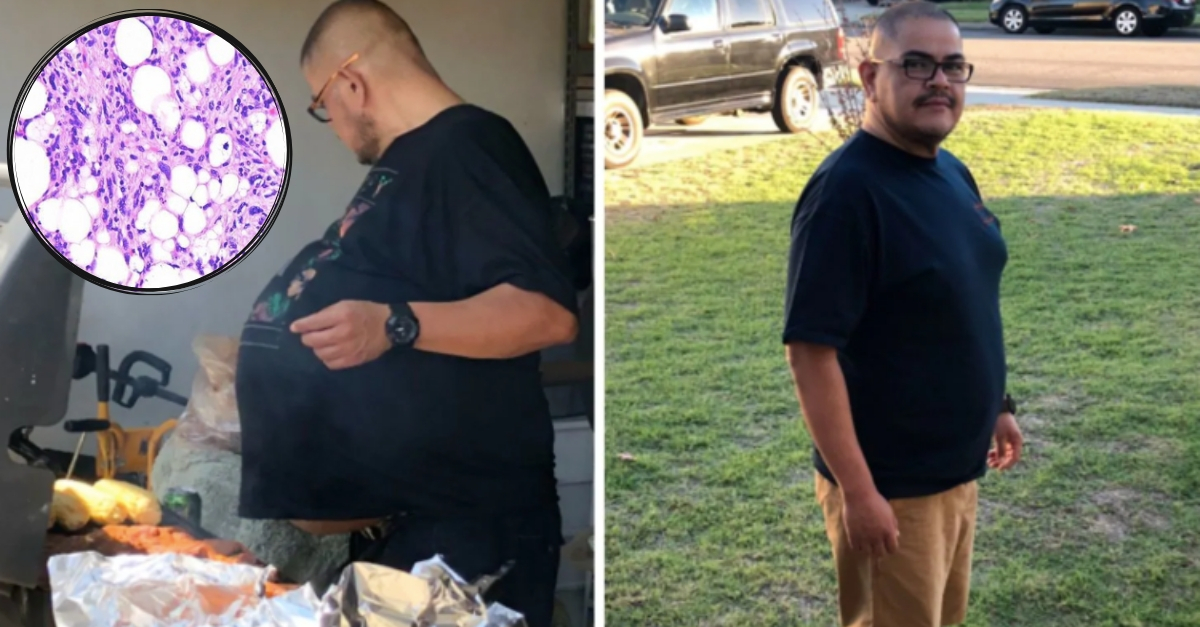 Man Teased For 'Beer Belly' Discovers It's Actually A 77Pound