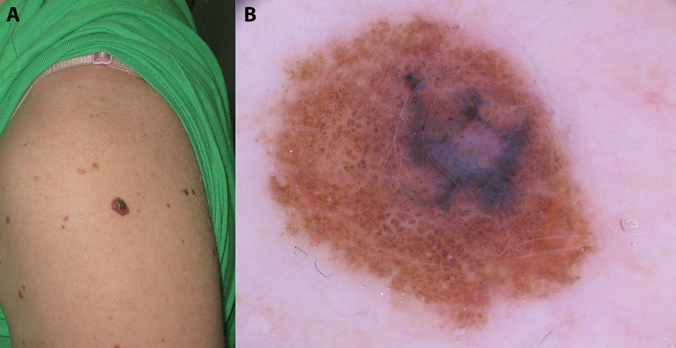 Reassessing the Biological Significance of Congenital Melanocytic Nevi