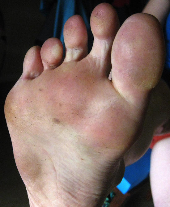 Toe blisters Backpacking Light
