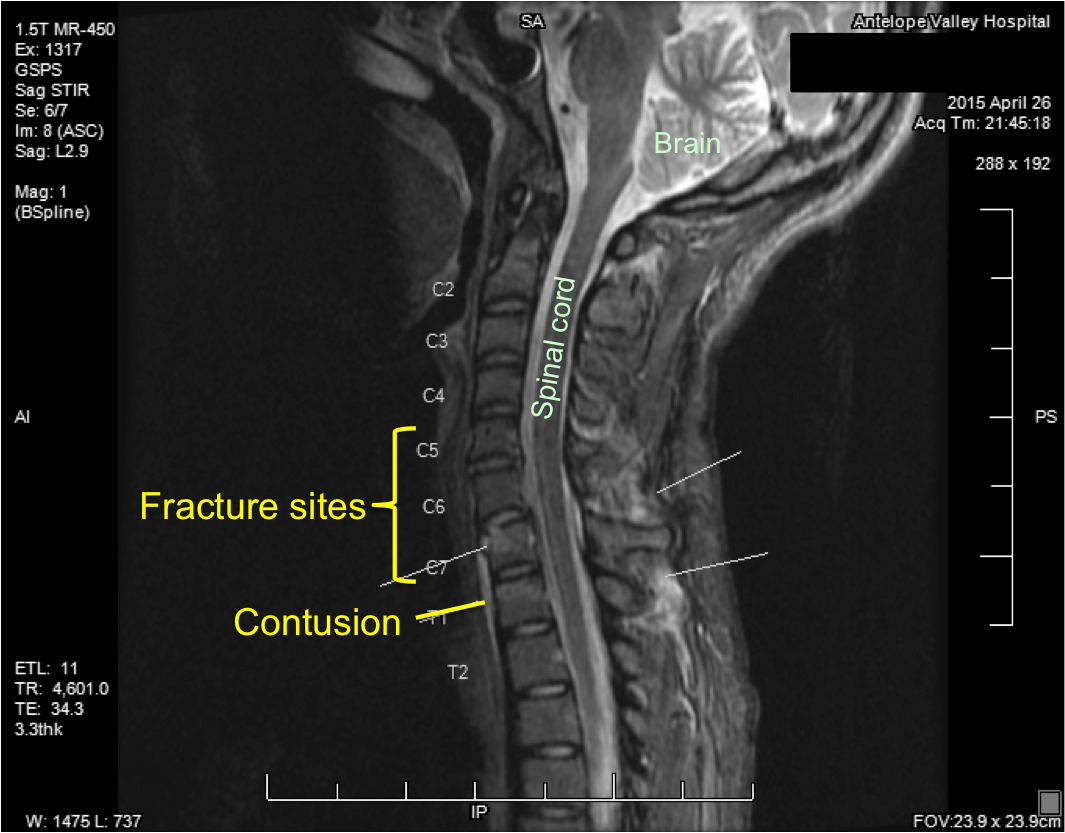 My neck injury Keeping my head up high