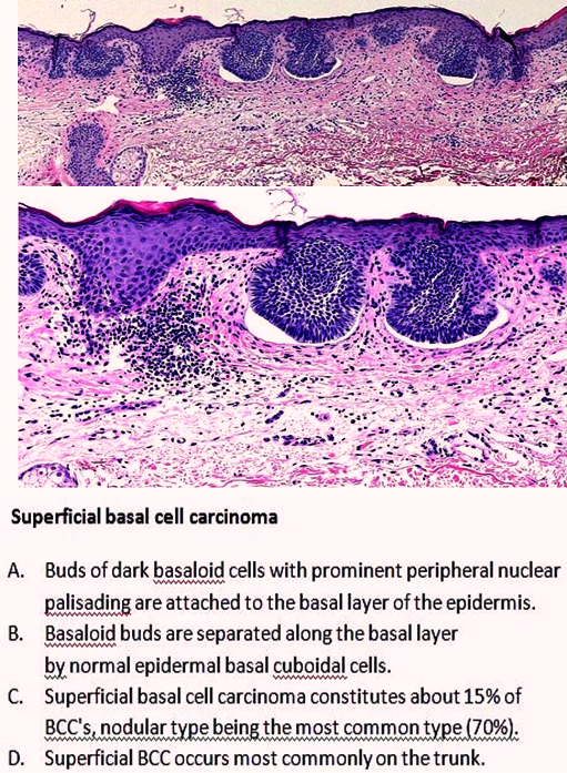 Quick pattern diagnosis Superficial basal cell carcinoma Dr Sarma's