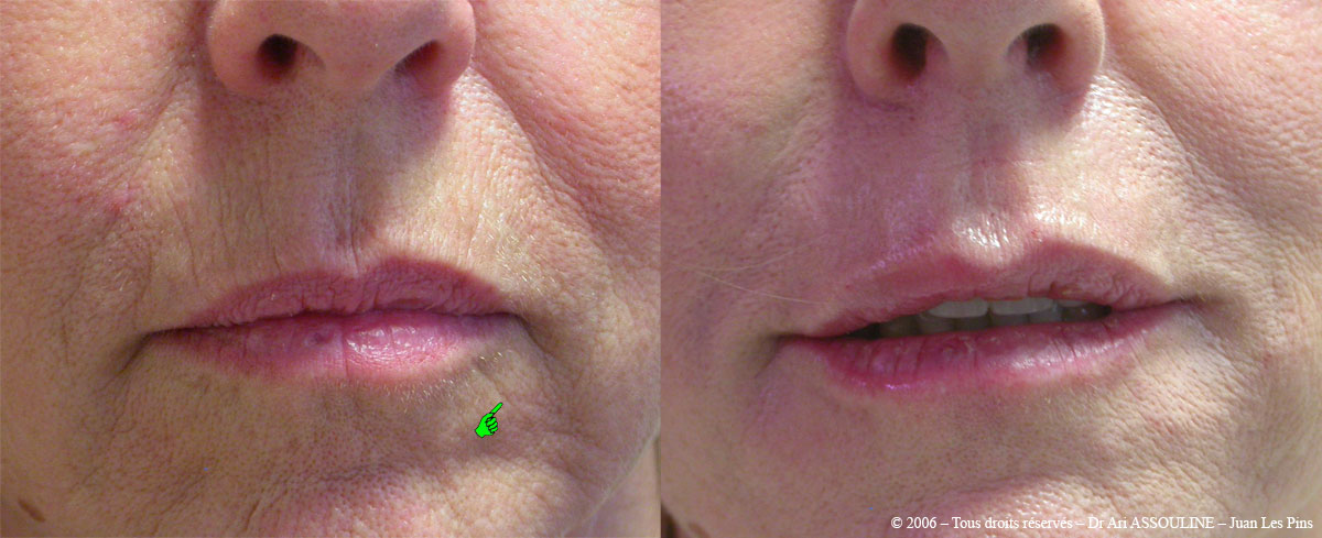 MEDECINE ESTHETIQUE du Dr. Ari ASSOULINE ANTIBES