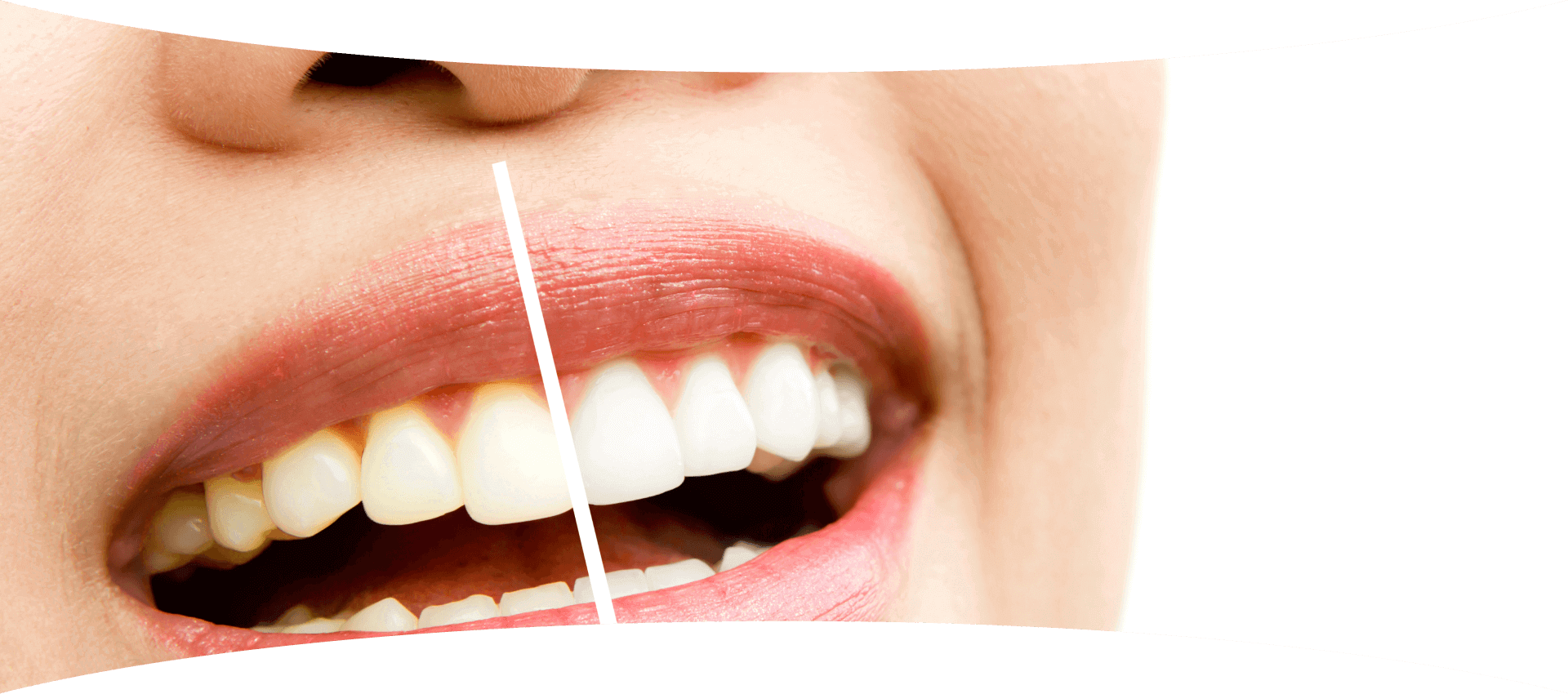 Bleaching Zahnarztpraxis Dr. Jennifer Bitzer M. Sc.