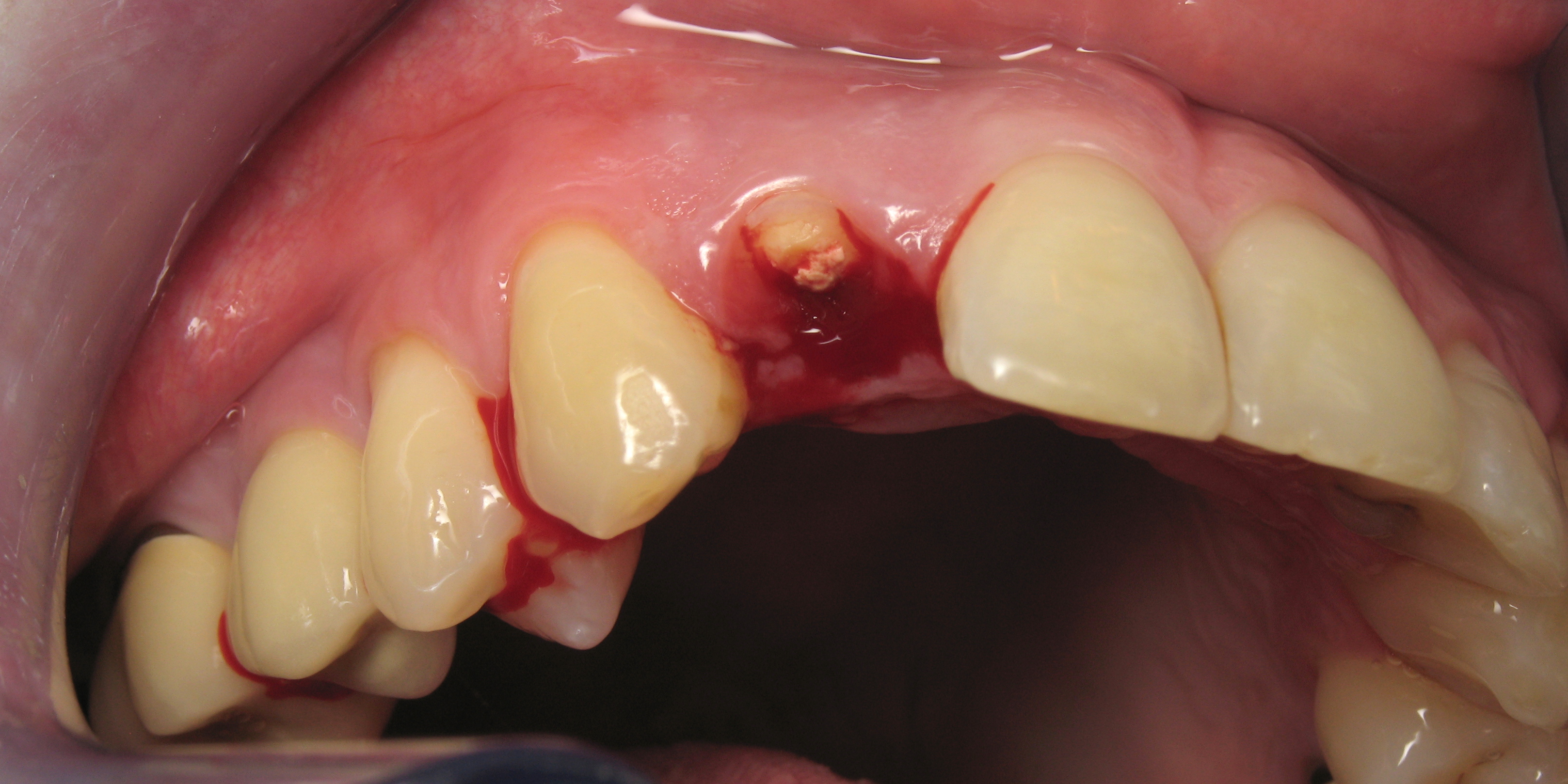 Couronne sur implant Bassens (73000) Dentiste Dr Pascal Simon & Dr