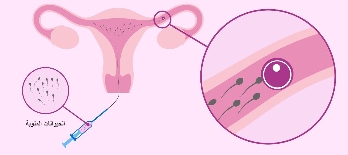 عوامل نجاح عملية التلقيح الصناعي الدكتور مازن الرواشدة