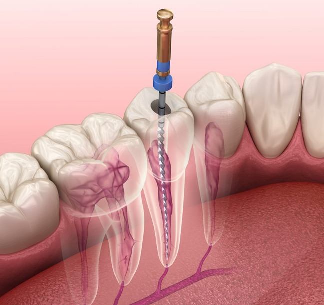 Root Canal Therapy Sunset FL Root Canal Dentist Miami, FL