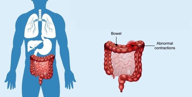 Is Bowel/Poop Leakage A Sign Of Cancer? | Oasis Clinic