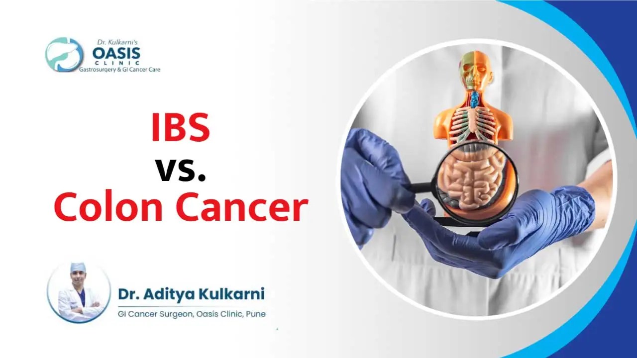 IBS vs. Colon Cancer Diagnosis, Treatment and Management