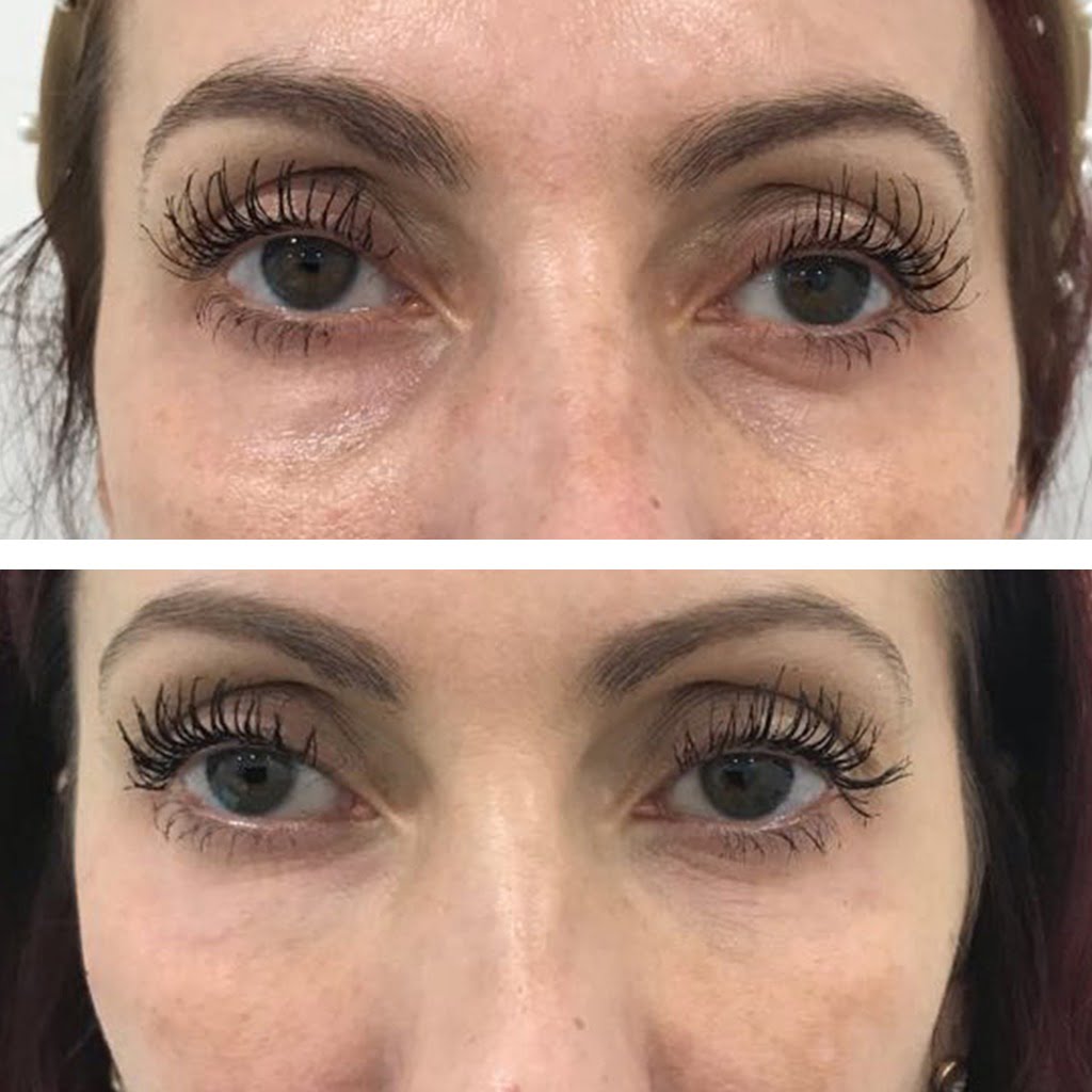 Tear Trough Fillers Botox Before And After Before And After Tear