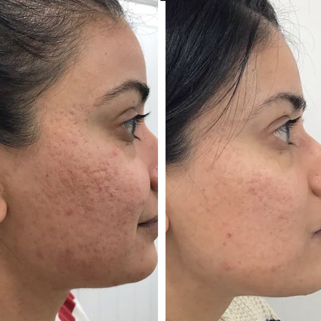 How does microneedling work?
