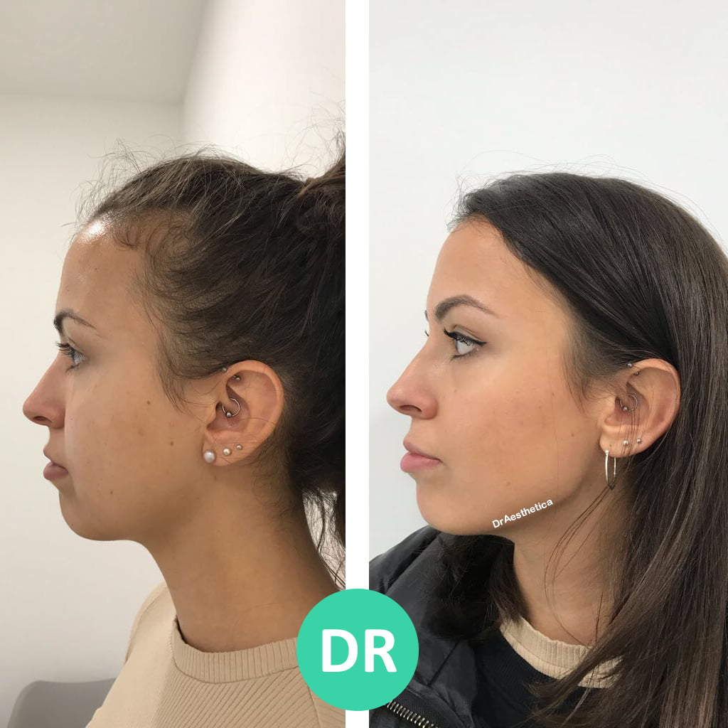 Jawline Slimming & Bruxism Treatment Dr Aesthetica