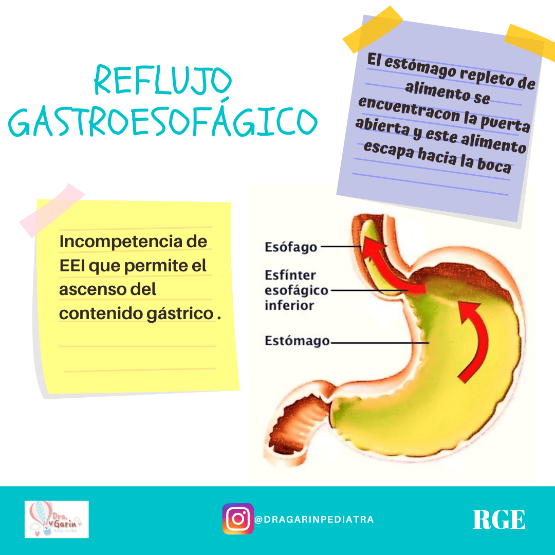 REFLUJO GASTROESOFÁGICO Síntomas Causas y Tratamiento MD Saúde Sexiz Pix