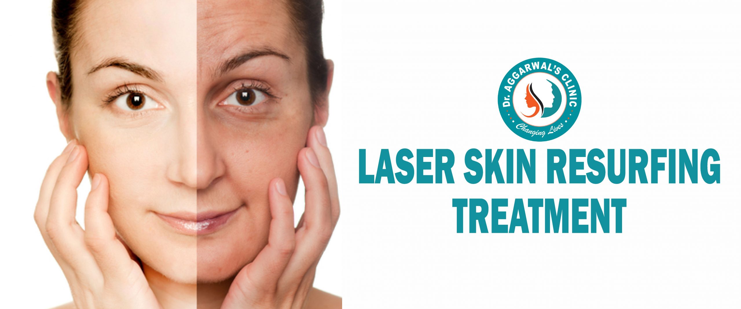 Laser Skin Resurfing Treatment In Jodhpur DrAggarwalsClinic