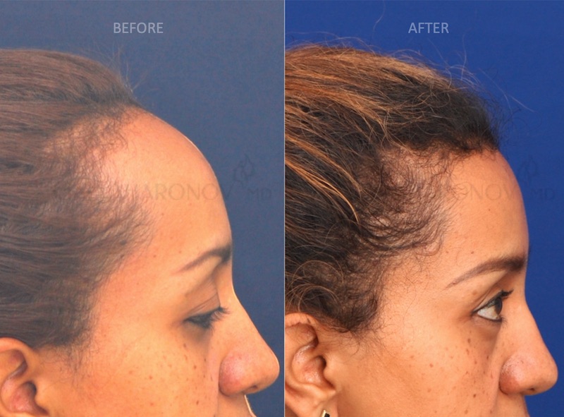 Hairline Lowering Surgery Plastic Surgery