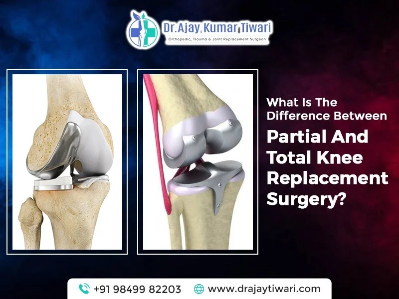 Partial Knee Replacement