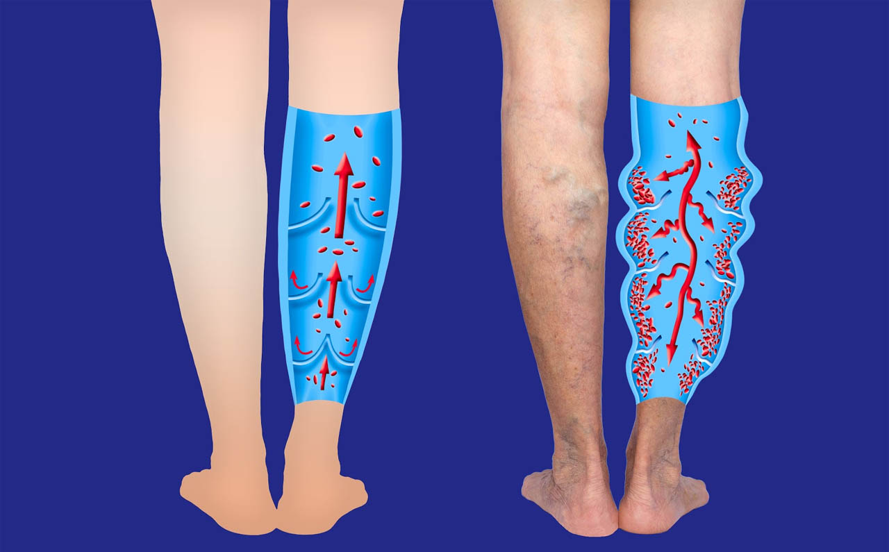 Surgery Vs Laser Treatment For Varicose Veins Dr. Akhil Monga