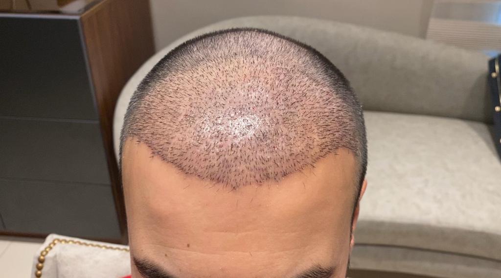 Is hair transplant safe? The 5 most important factors for choosing