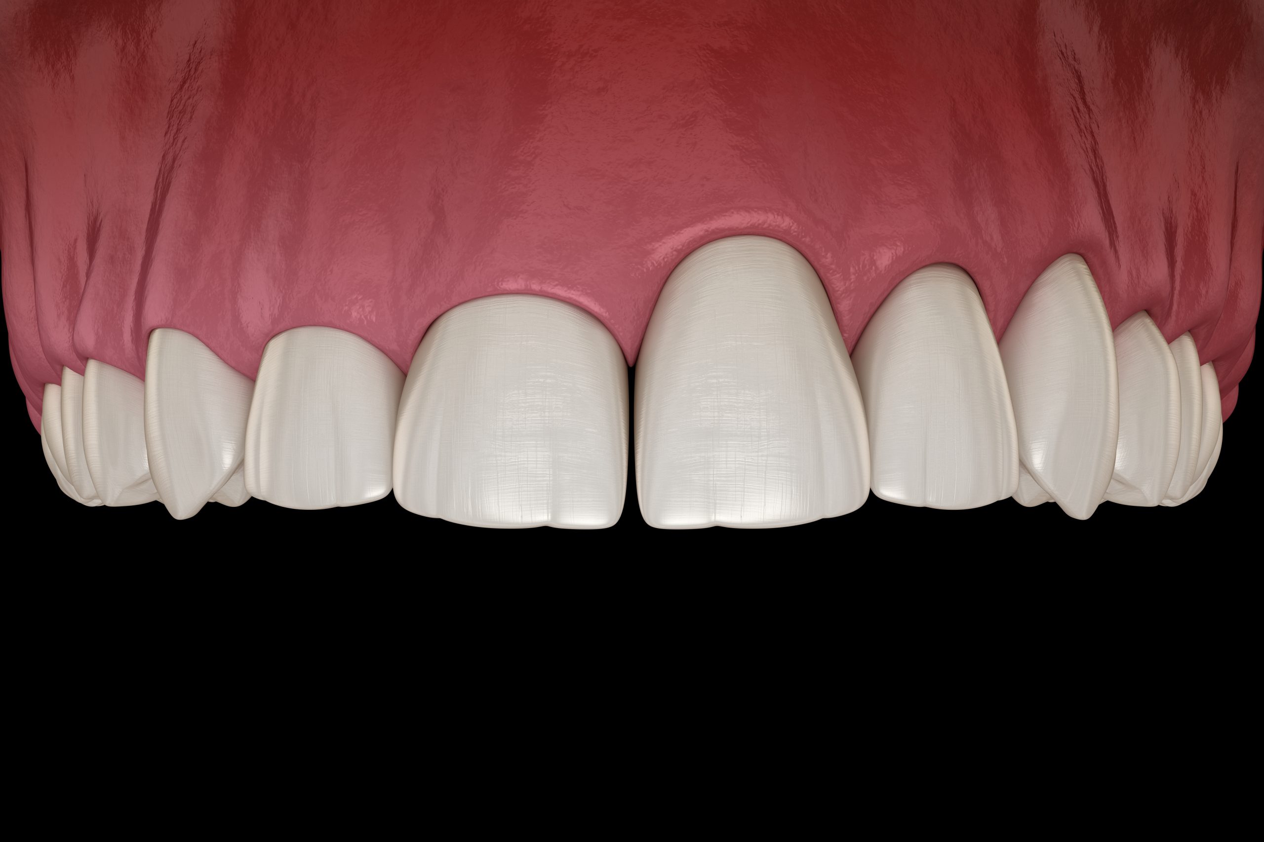 An Introduction To Tooth Contouring Treatment Dr. Alex Midtown NYC