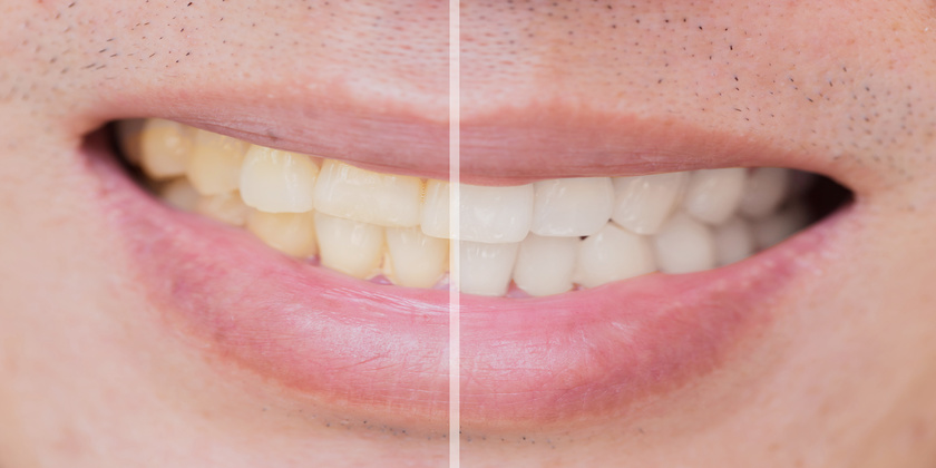 What Are The Different Types Of Tooth Staining? Cosmetic Dentist Dr