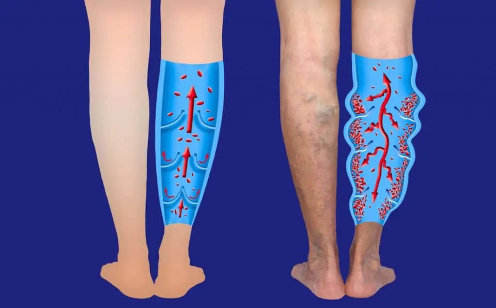 What You Need To Know About Venous Insufficiency Chiropractic