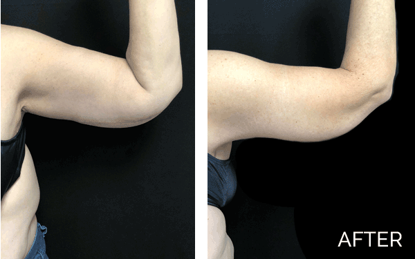How to Get Rid of Flabby Arms & Loose Arm Skin Dr Ali