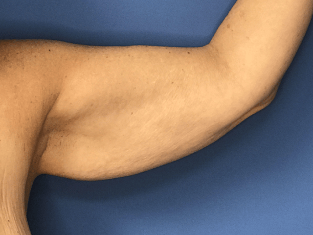 How to Get Rid of Flabby Arms & Loose Arm Skin Dr Ali
