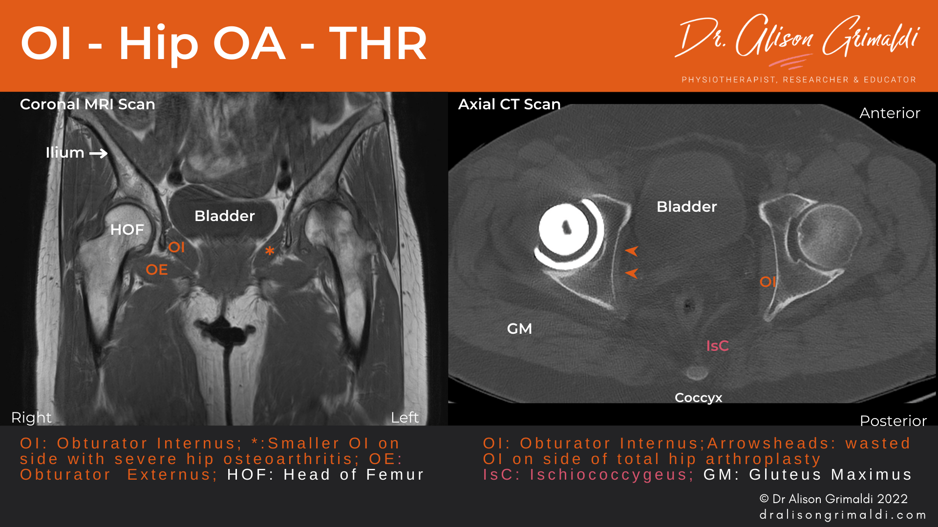 The hip and pelvic floor Let's get it together! Find out more