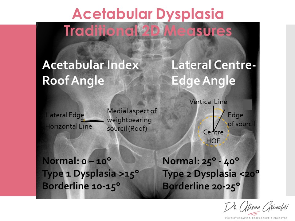 Acetabular Dysplasia seeing the whole picture Dr Alison Grimaldi