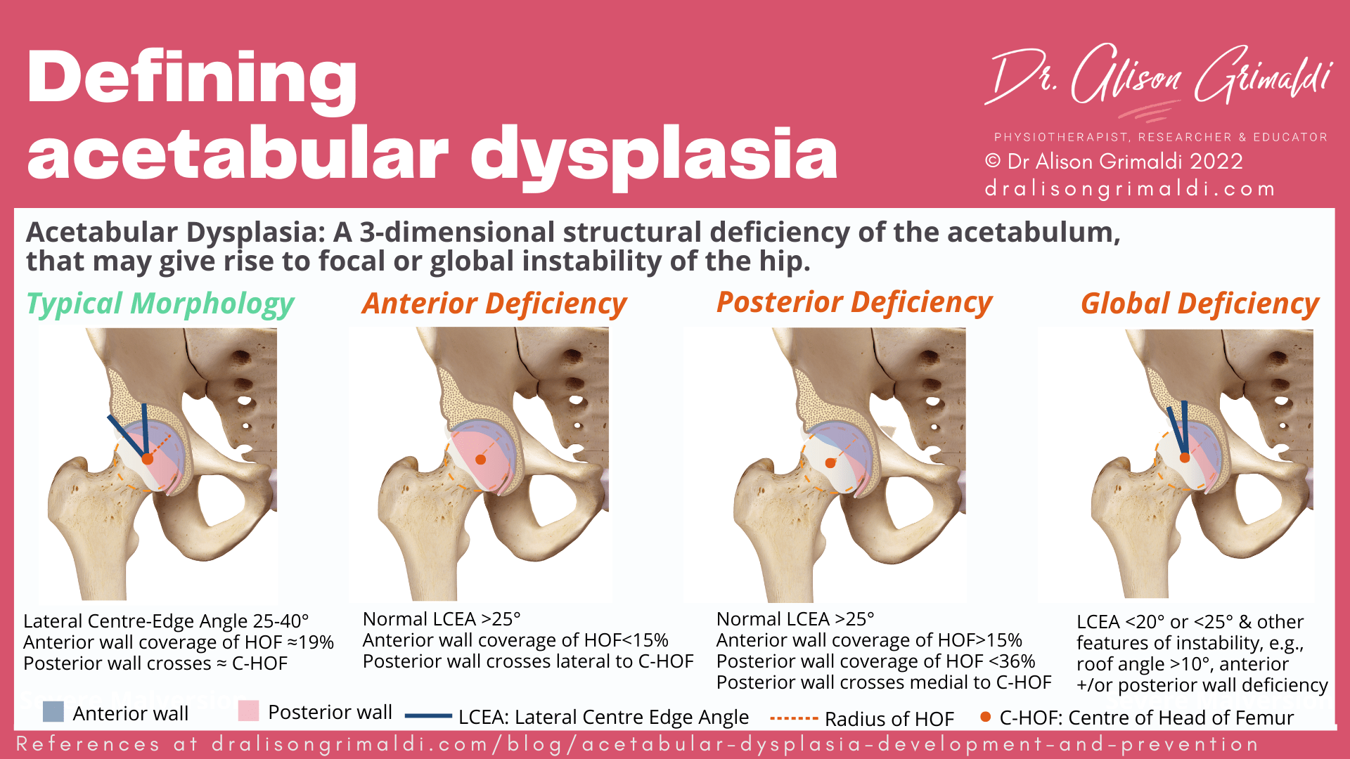 Acetabular Dysplasia Development and Prevention Find out more