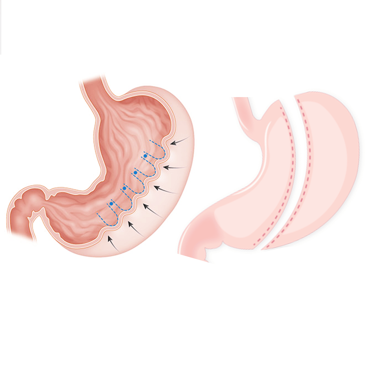 Endoscopic gastroplasty versus laparoscopic sleeve gastrectomy a