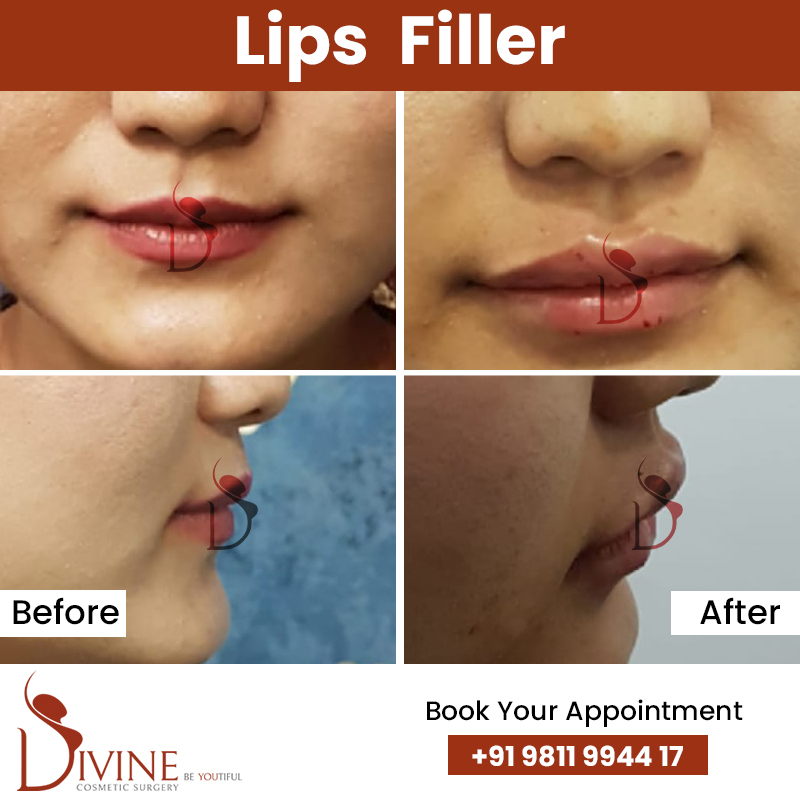 Lips Surgery In India