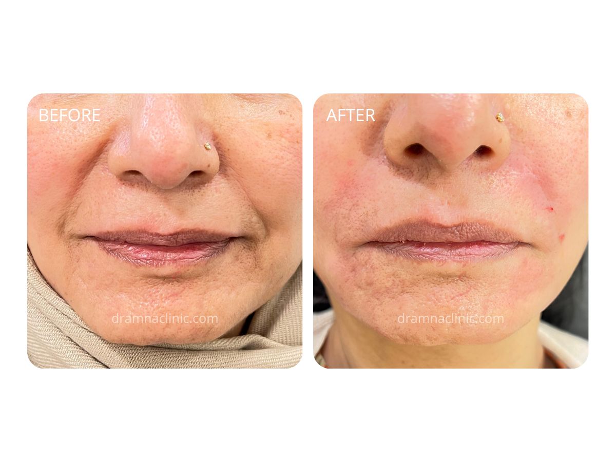 Dermal Fillers Benefits & Uses Dr Amna's Clinic