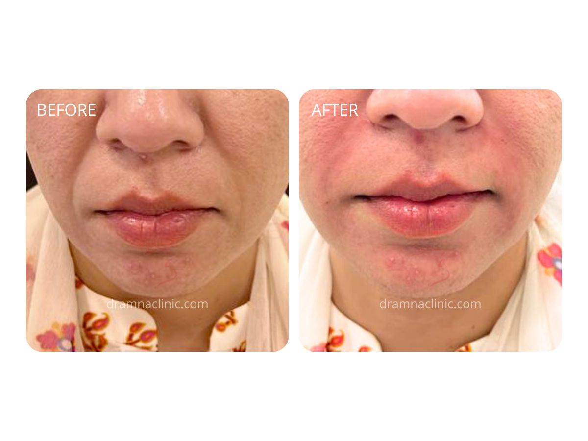 Dermal Fillers Benefits & Uses Dr Amna's Clinic