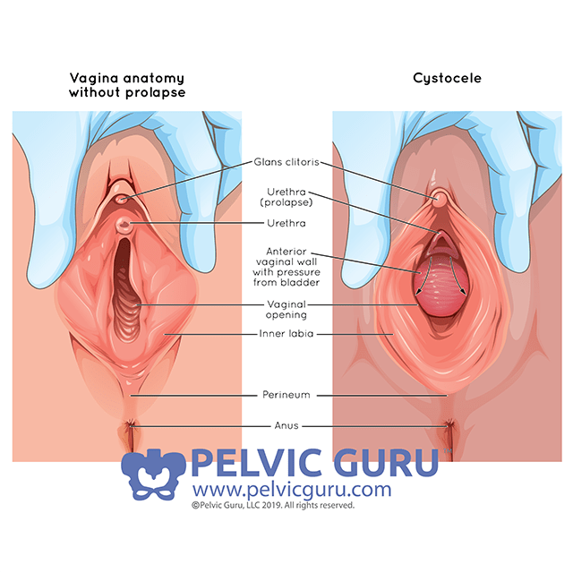 Prolapse! Now, What? - Dr Amruta Inamdar - Pelvic Floor Physical Therapy