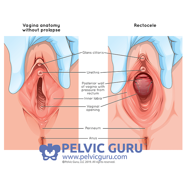 Prolapse! Now, What? - Dr Amruta Inamdar - Pelvic Floor Physical Therapy