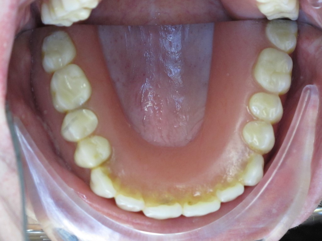 Tooth Borne Palateless Overdentures utilizing Ceka attachments and