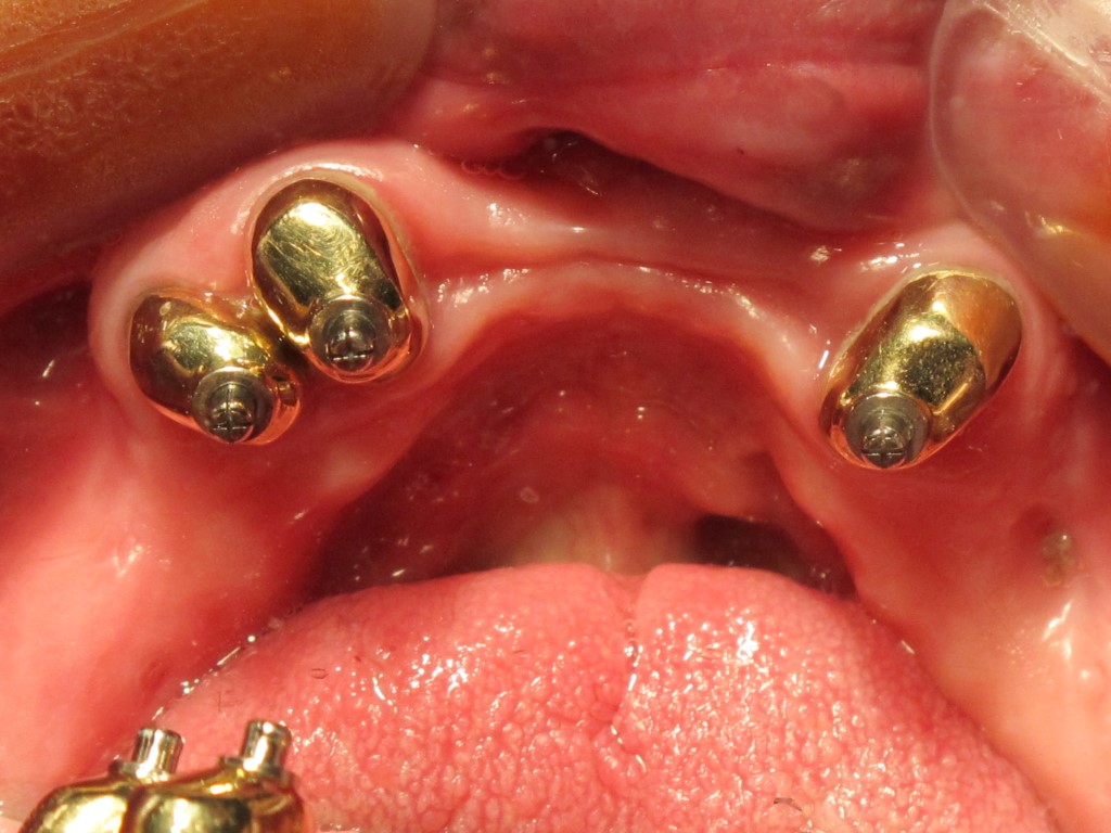 Tooth Borne Palateless Overdentures utilizing Ceka attachments and