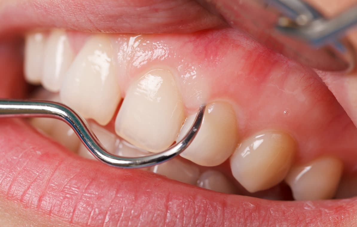Color Changes To Your Gums | Boulder Dentist | Family & Cosmetic Dentistry | Dr Ania Mohelicki