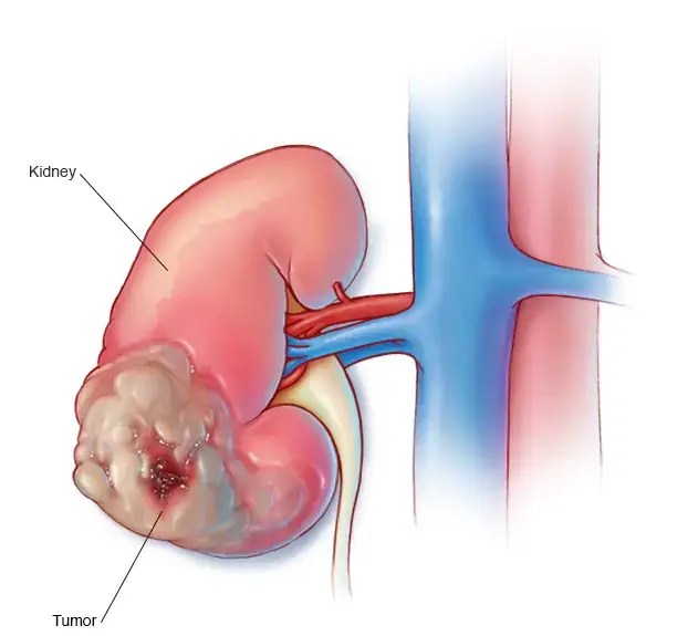 Best Kidney Cancer Treatment Doctor in Bangalore Dr. Anil Kumar T