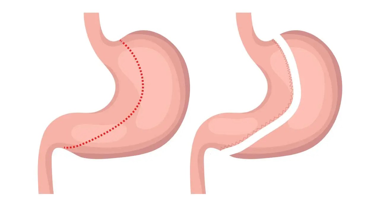 Gastric Sleeve Surgery Everything You Need to Know