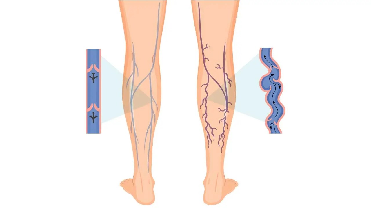 Varicose Veins Everything You Need to Know